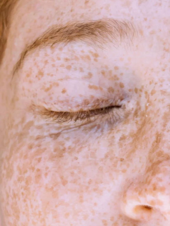Tache brune et grain de peau irrégulier autour de l’œil fermé, peau clairsemée avec des melasma léger.