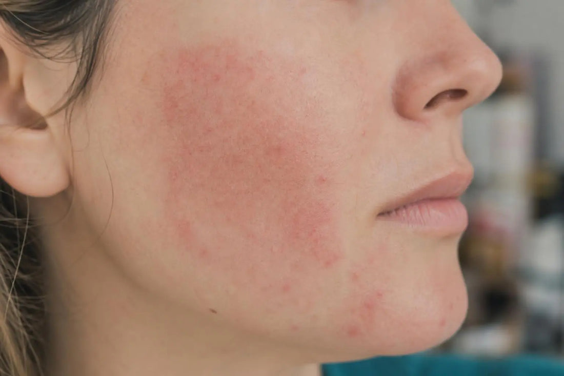 Allergie cosmétique : symptômes à reconnaître sur votre peau