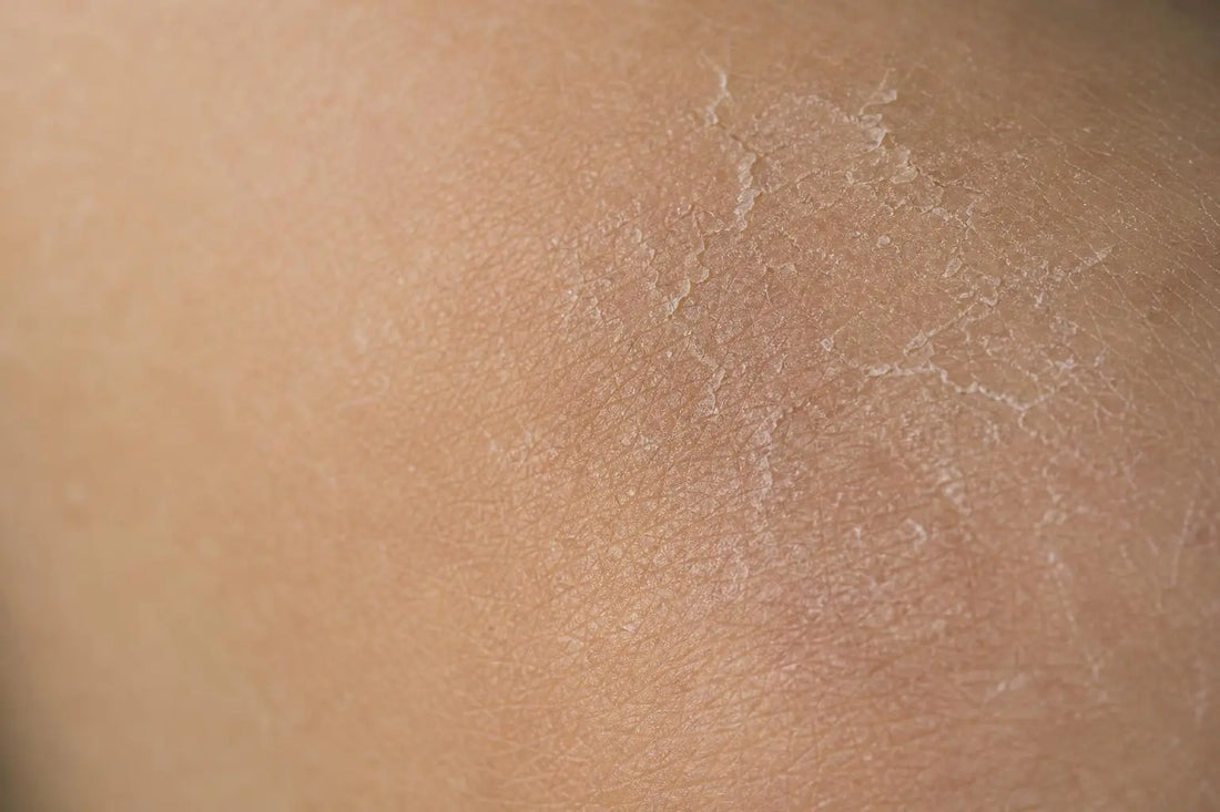Comment renforcer la barrière cutanée et réparer sa peau fragilisée