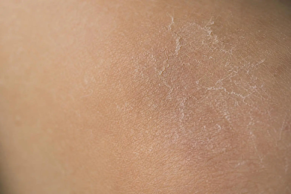 Comment renforcer la barrière cutanée et réparer sa peau fragilisée Image