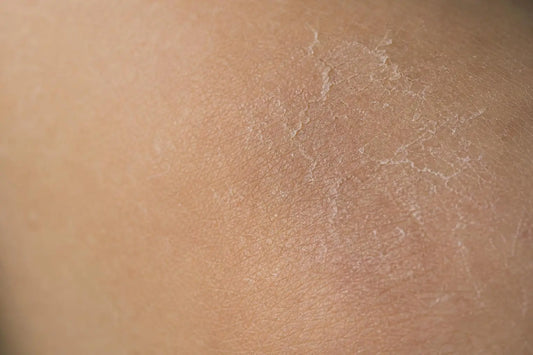 Comment renforcer la barrière cutanée et réparer sa peau fragilisée