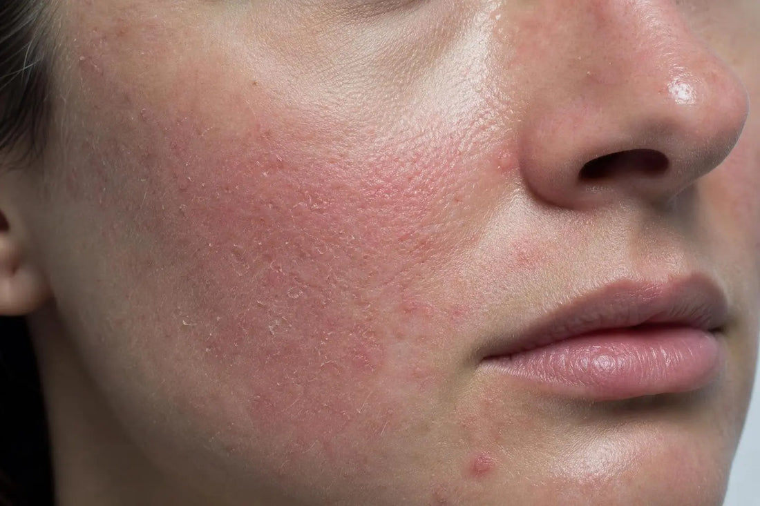 Barrière cutanée endommagée : symptômes et signes à reconnaître